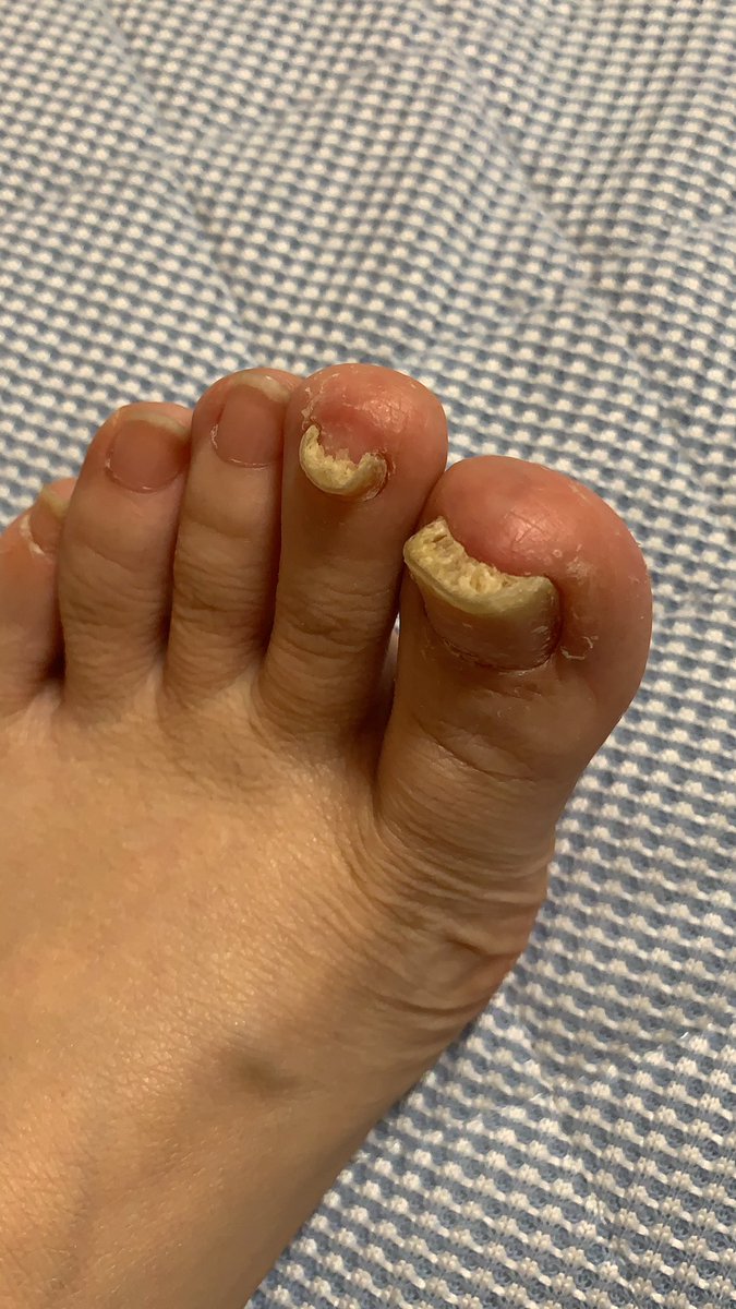 月子 アトピー性皮膚炎がトレンド入りしてますね 私も子供の頃アトピーだった 今は 掌蹠膿疱症 だ 読み方は しょうせきのうほうしょう ググってみて 凄い画像出てくるよ 皮が剥がれて歩くの辛い時はラップ巻く 巻き爪を繰り返す T 月子 アトピー性皮膚炎がトレンド入りしてますね 私も子供の頃アトピーだった 今は 掌蹠膿疱症 だ 読み方は しょうせきのうほうしょう ググってみて 凄い画像出てくるよ 皮が剥がれて歩くの辛い時はラップ巻く 巻き爪を繰り返す T