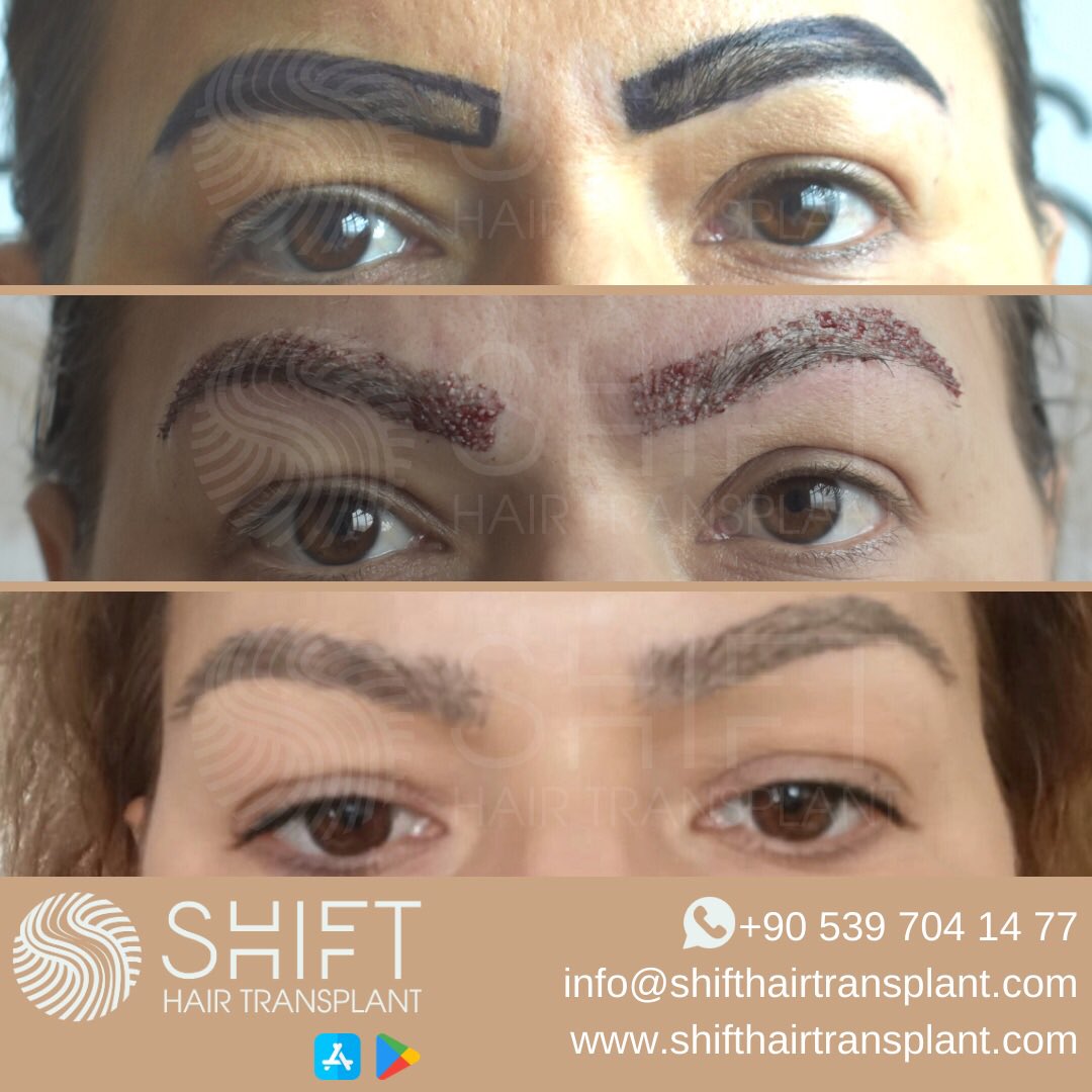 SHIFT Hair Transplant on Twitter: SHIFT Hair Transplant on Twitter: