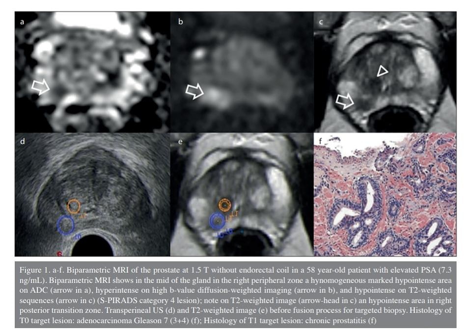 July 2019 Issue 4 Volume 45

The review of the current knowledge about multiparametric and biparametric MRI of the prostate

#MRI #prostate #uroonco #fusionbiopsy #urology #prostatebiopsy #prostatecancer #Cancer #tbt #UroSoMe #openaccess

Article Link :

turkishjournalofurology.com/en/prostate-mr…