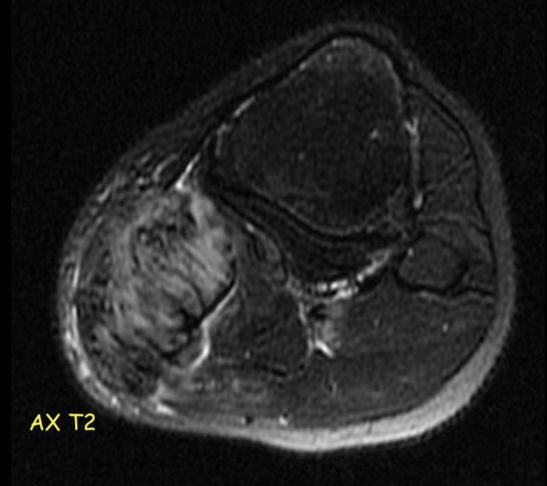 Like all discussions, our main hypothesis were Desmoid tumor and MPNST. An US-guided biopsy was performed and a Desmoid tumor was confirmed. Patient returned 1 year later with an important increase in tumor volume. #desmoidtumor #amputationsurgery #mskradiology #mri