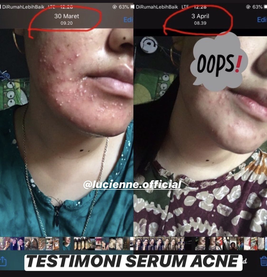 lucienne serum acne