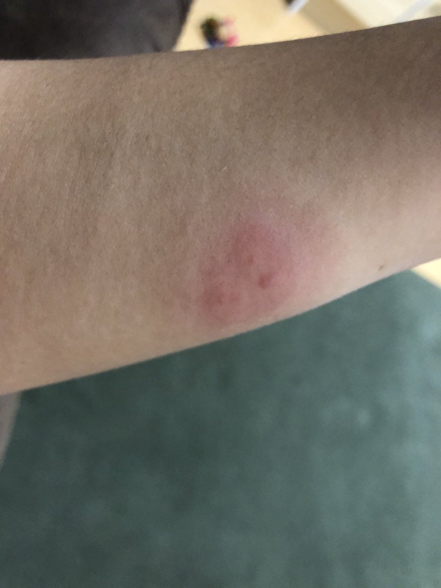 Maimai 昨日の虫さされっぽいやつ 今日めっちゃはれた 左右で腕の太さがぜんぜん違う まじ痒い なんなのこれ 噛まれた後が4つあるから蚊ではなさそうだけど Maimai 昨日の虫さされっぽいやつ 今日めっちゃはれた 左右で腕の太さがぜんぜん違う まじ痒い なんなのこれ 噛まれた後が4つあるから蚊ではなさそうだけど