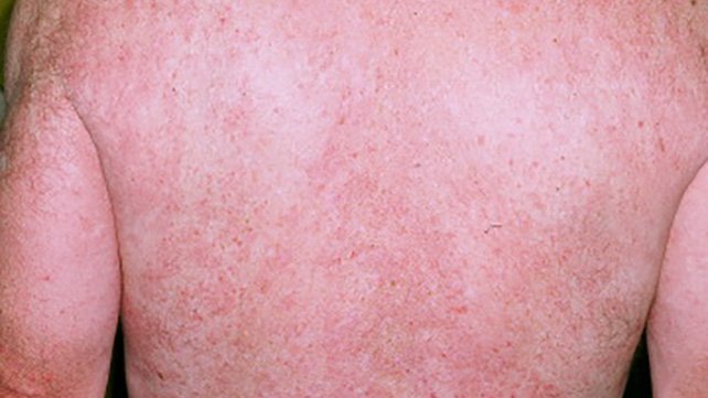 Ifumsaquizclub's tweet photo. BCl Thursday💊👨🏽💼👩🏻
💥RED MAN SYNDROME
aka red neck syndrome
Red man syndrome is the most common adverse reaction to the drug Vancomycin.
💡The name comes from the red rash that develops on the face, neck, and torso of affected people.
#BasicClinicals
#IQDCOAU https://t.co/1kPVAcMGu2
