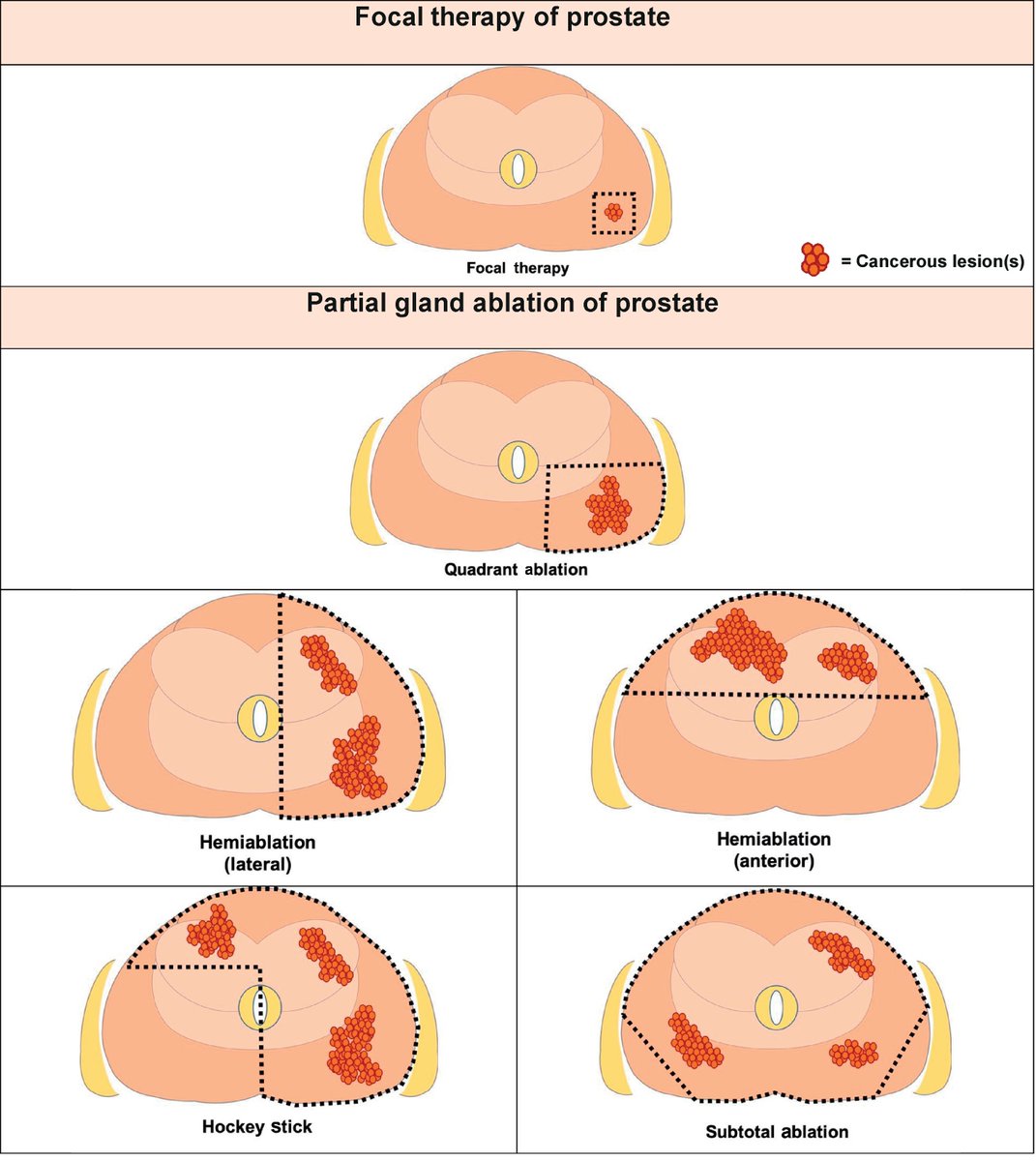 European Urology (@euplatinum) on Twitter photo Standardized Nomenclature and Surveillance Methodologies After Focal Therapy and Partial Gland Ablation for Localized PCa: An International Multidisciplinary Consensus
<a href="/AmirLebastchi/">Amir Lebastchi, MD</a> <a href="/arvinkgeorge/">Arvin K. George, MD</a> <a href="/ThomasPolascik/">Thomas Polascik</a> <a href="/michael_gorin/">Michael Gorin, M.D.</a> <a href="/RSanchezSalas/">RodolfoSanchez-Salas</a> <a href="/PChoyke/">Peter Choyke</a>
buff.ly/3cRtmKj Standardized Nomenclature and Surveillance Methodologies After Focal Therapy and Partial Gland Ablation for Localized PCa: An International Multidisciplinary Consensus
<a href="/AmirLebastchi/">Amir Lebastchi, MD</a> <a href="/arvinkgeorge/">Arvin K. George, MD</a> <a href="/ThomasPolascik/">Thomas Polascik</a> <a href="/michael_gorin/">Michael Gorin, M.D.</a> <a href="/RSanchezSalas/">RodolfoSanchez-Salas</a> <a href="/PChoyke/">Peter Choyke</a>
buff.ly/3cRtmKj