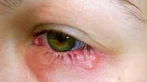 EconomicsHealth's tweet photo. #Health Economics 2020, #Euroscicon
#Sep 28-29, 2020, #Amsterdam, Netherlands
#The patient’s visual acuity with glasses is in the ratio 20/20 for each eye. Furthermore, flourescein stain is negative for corneal abrasion. https://t.co/vSMb22e9UK