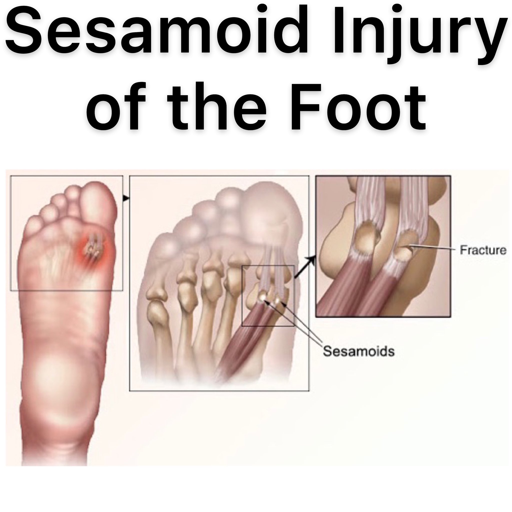 Sports Physiotherapist on Twitter "SESAMOID INJURY OF THE FOOT ⠀ The