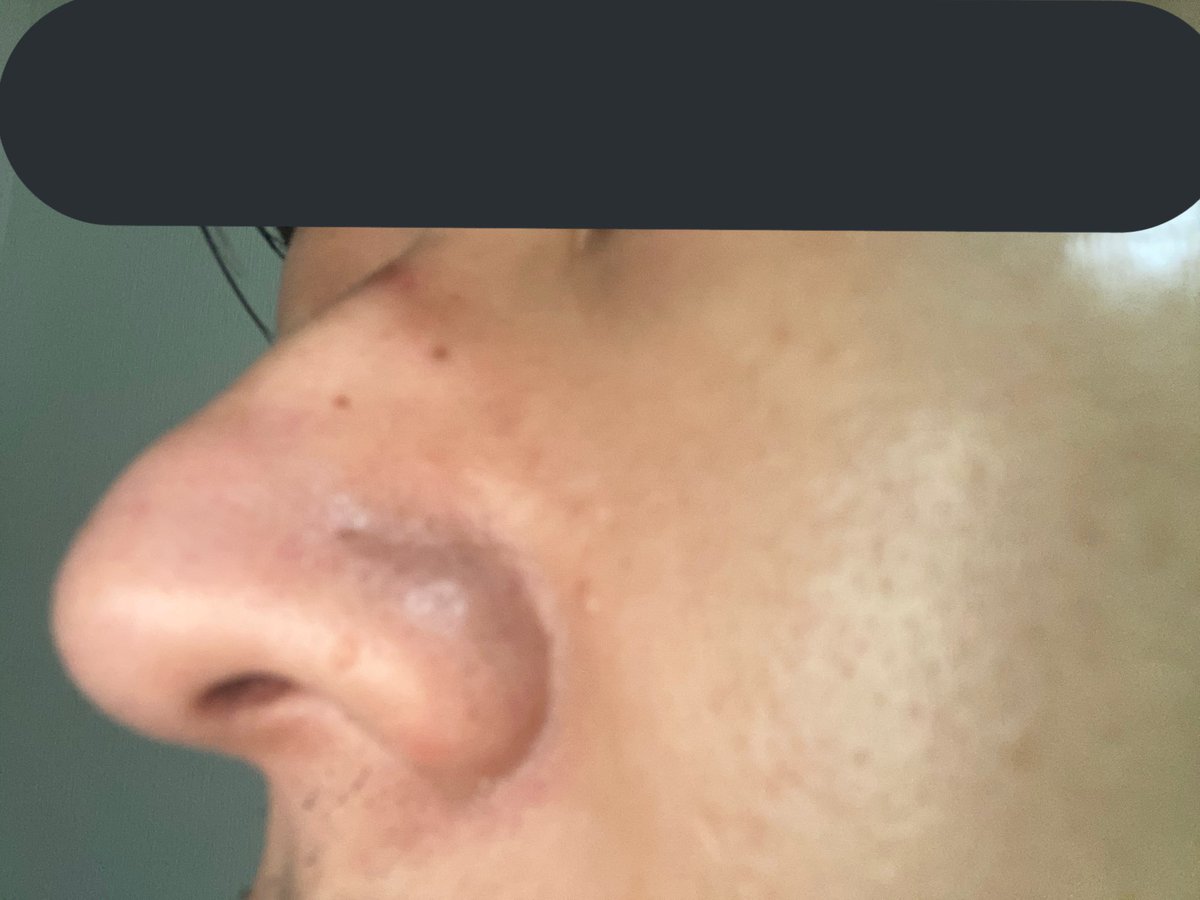 剛毛男爵 メンズ脱毛のプロ患者 スキンケア2日目 分かりにくいとは思うのですが 鼻の両サイドの黒ずみを落としたいんですよね あとは頬 眼窩底あたり の毛穴の開きが無くなるとなお良い コツコツやっていきましょ ドm男爵人体実験