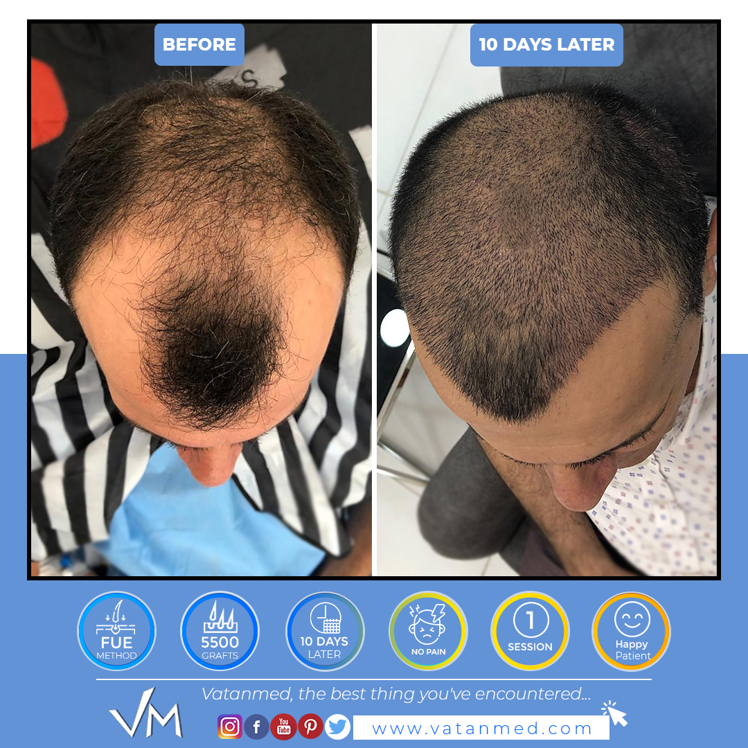 Twitter 上的 VATANMED Hair Transplant: Twitter 上的 VATANMED Hair Transplant: