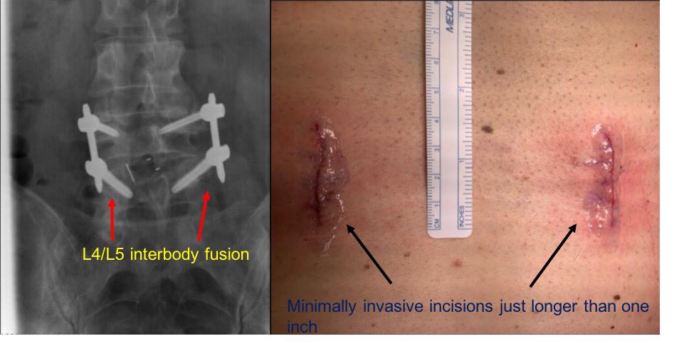 50 yo male with back&amp;leg pain that made it difficult to walk and stand underwent minimally invasive, robotically assisted lumbar fusion by Dr Mark Jacobson. The patient had complete resolution of pain and returned to normal activity! We are leaders in innovation. #orthotwitter