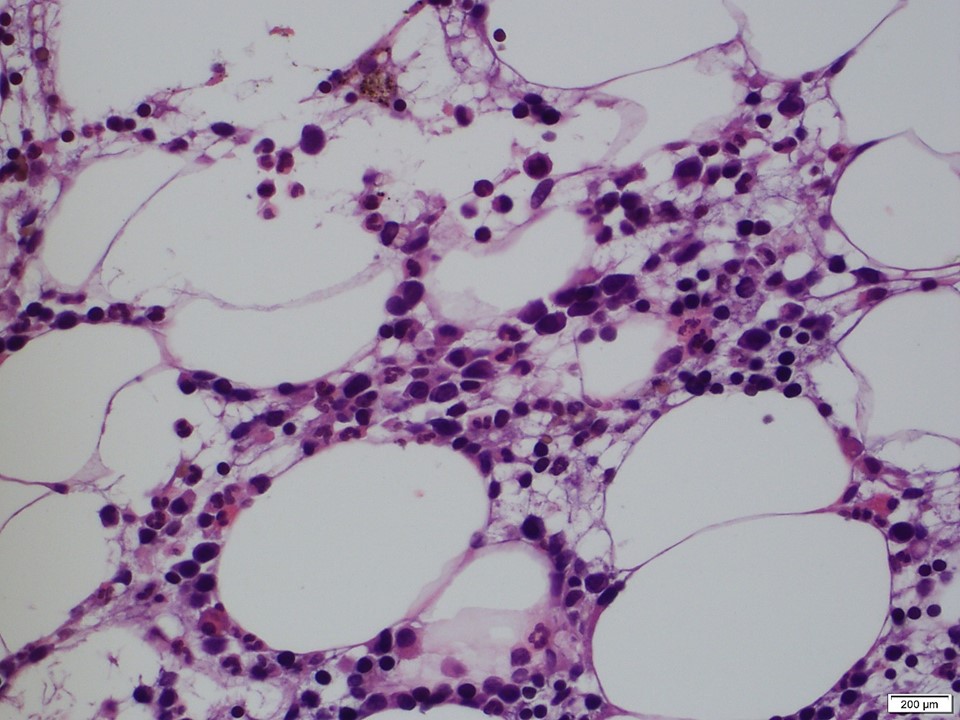 SibaElHussein's tweet photo. Case 2: HSTL
@RMirandaMD 

#hemepath #VirtualHemepathMDA #hemepathMDA #Virtualpath https://t.co/6TUWEaGVBS