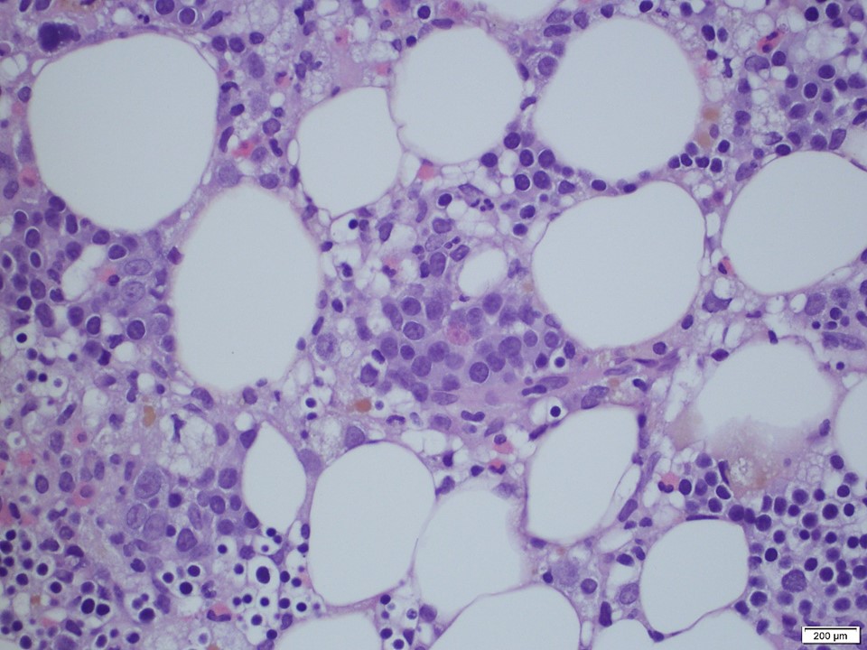SibaElHussein's tweet photo. Case 3: T-LGL

#hemepath #VirtualHemepathMDA #hemepathMDA #Virtualpath https://t.co/9SL7Xmr50d