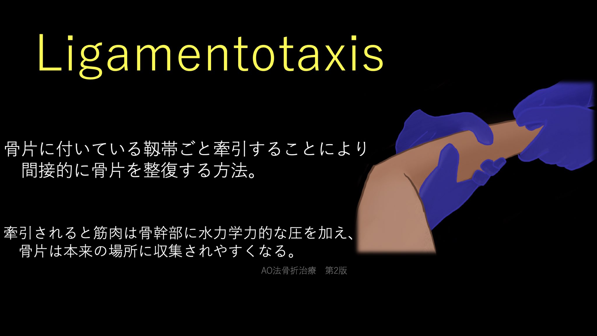 ユジカワ 整形dr イラストレーター 骨折の整復において 何となく引っ張って治すのと リガメントタキシスを意識して治すのでは次元が違う 非観血的な整復や 創外固定による整復は概ねこれによるもの 骨折部の周囲の筋や靭帯の付着まで意識して ユジカワ 整形dr イラストレーター 骨折の整復において 何となく引っ張って治すのと リガメントタキシスを意識して治すのでは次元が違う 非観血的な整復や 創外固定による整復は概ねこれによるもの 骨折部の周囲の筋や靭帯の付着まで意識して