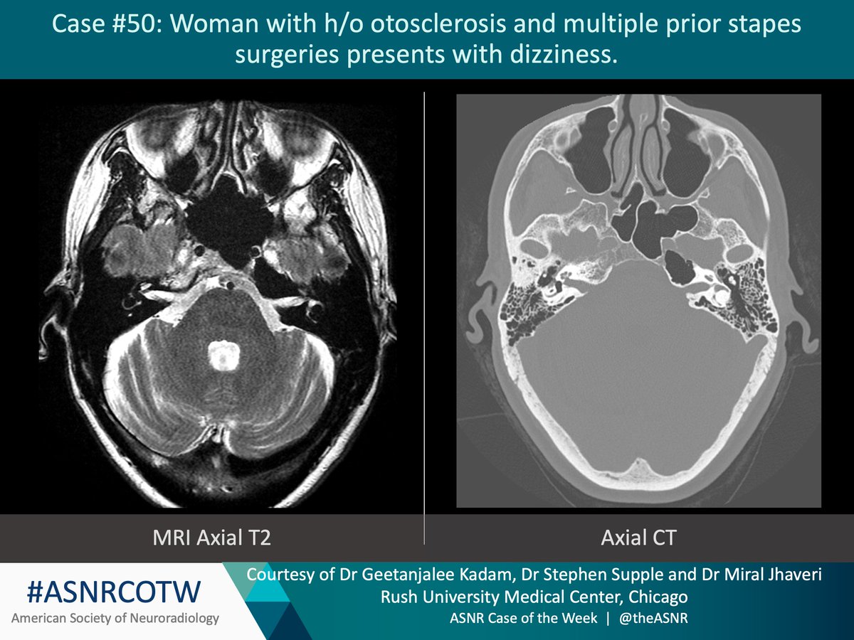 TheASNR's tweet photo. ASNR COTW #50

Hx: Dizziness. Prior stapes operations. 

Case c/o Drs. Geetanjalee Kadam, Stephen Supple, and Miral Jhaveri at Rush.

No SPOILERS. ONLY GIVE HINTS in form of GIF or answer in attached poll. 

Answer posted in 24 hrs.

#radres #neurorad #FOAMrad #meded #ASNRCOTW https://t.co/GlaCIXC0ap