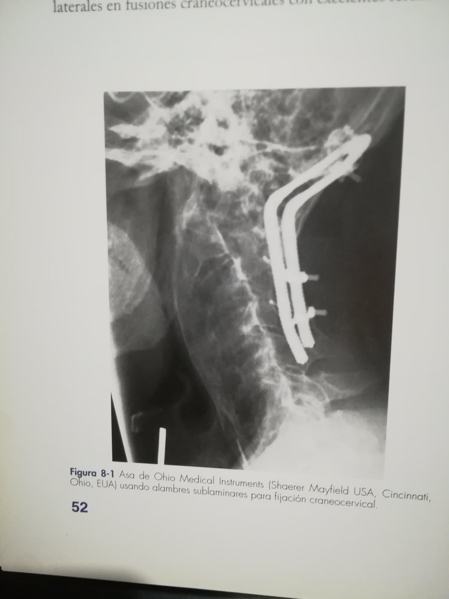 GeovannyCanar's tweet photo. FIJACIÓN CRANEOCERVICAL.

Esta fijación es dura y de alto riesgo.
2 imágenes de revisión anatómica previa. 

Y las otras 2 del resultado final.
El paciente sigue pintando.

EXCELENTE EQUIPO del IESS HTMC,

Los gestores fueron los de mayor experiencia. https://t.co/u52WLVqXEh