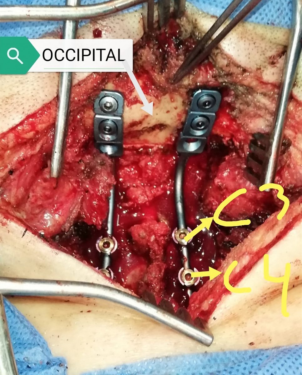 GeovannyCanar's tweet photo. FIJACIÓN CRANEOCERVICAL.

Esta fijación es dura y de alto riesgo.
2 imágenes de revisión anatómica previa. 

Y las otras 2 del resultado final.
El paciente sigue pintando.

EXCELENTE EQUIPO del IESS HTMC,

Los gestores fueron los de mayor experiencia. https://t.co/u52WLVqXEh