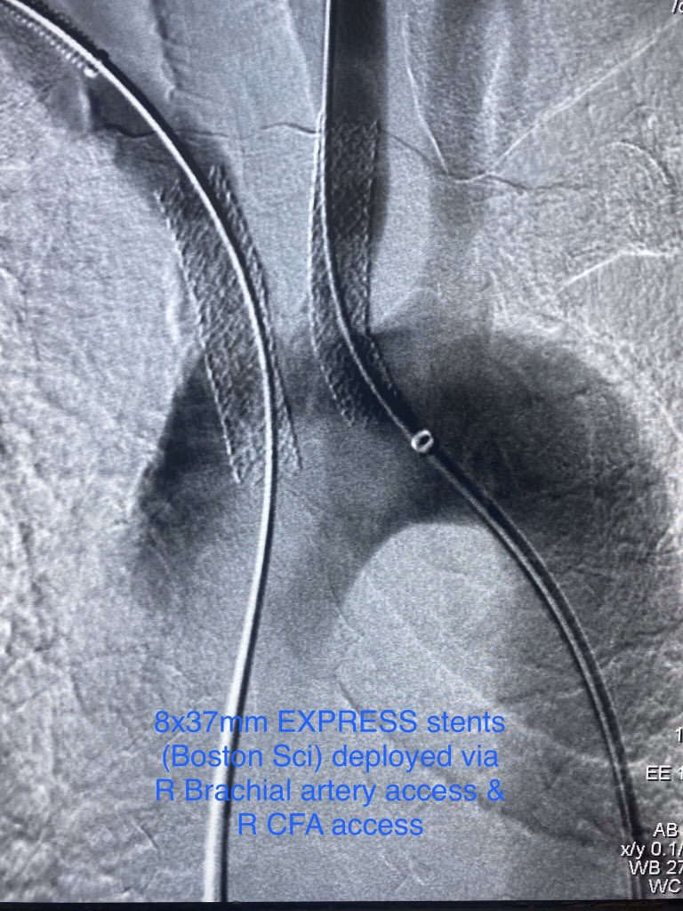 SoFloVIR's tweet photo. Px w/ recurrent syncope & severe RUE claudication w/ minimal activity. Subtotal occluded origins of brachiocephalic & L common carotid arteries. Tag team brachial/femoral approach revascularization by @DrBobBeasley @BOlivieriMD @OmoKinju #Endofirst #Irad #TwittIR https://t.co/mtwtIMsfLw