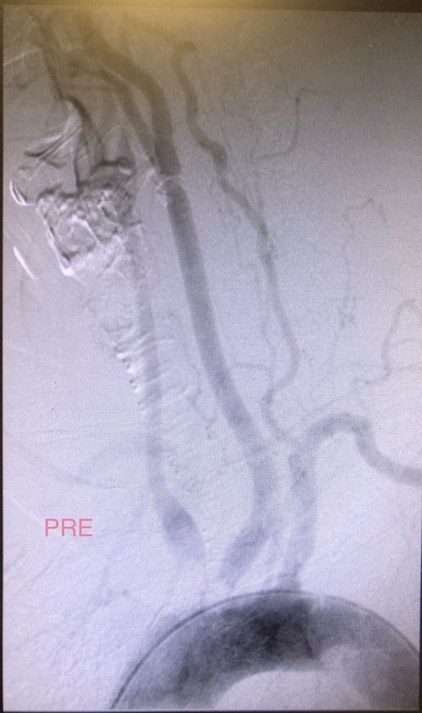 SoFloVIR's tweet photo. Px w/ recurrent syncope & severe RUE claudication w/ minimal activity. Subtotal occluded origins of brachiocephalic & L common carotid arteries. Tag team brachial/femoral approach revascularization by @DrBobBeasley @BOlivieriMD @OmoKinju #Endofirst #Irad #TwittIR https://t.co/mtwtIMsfLw