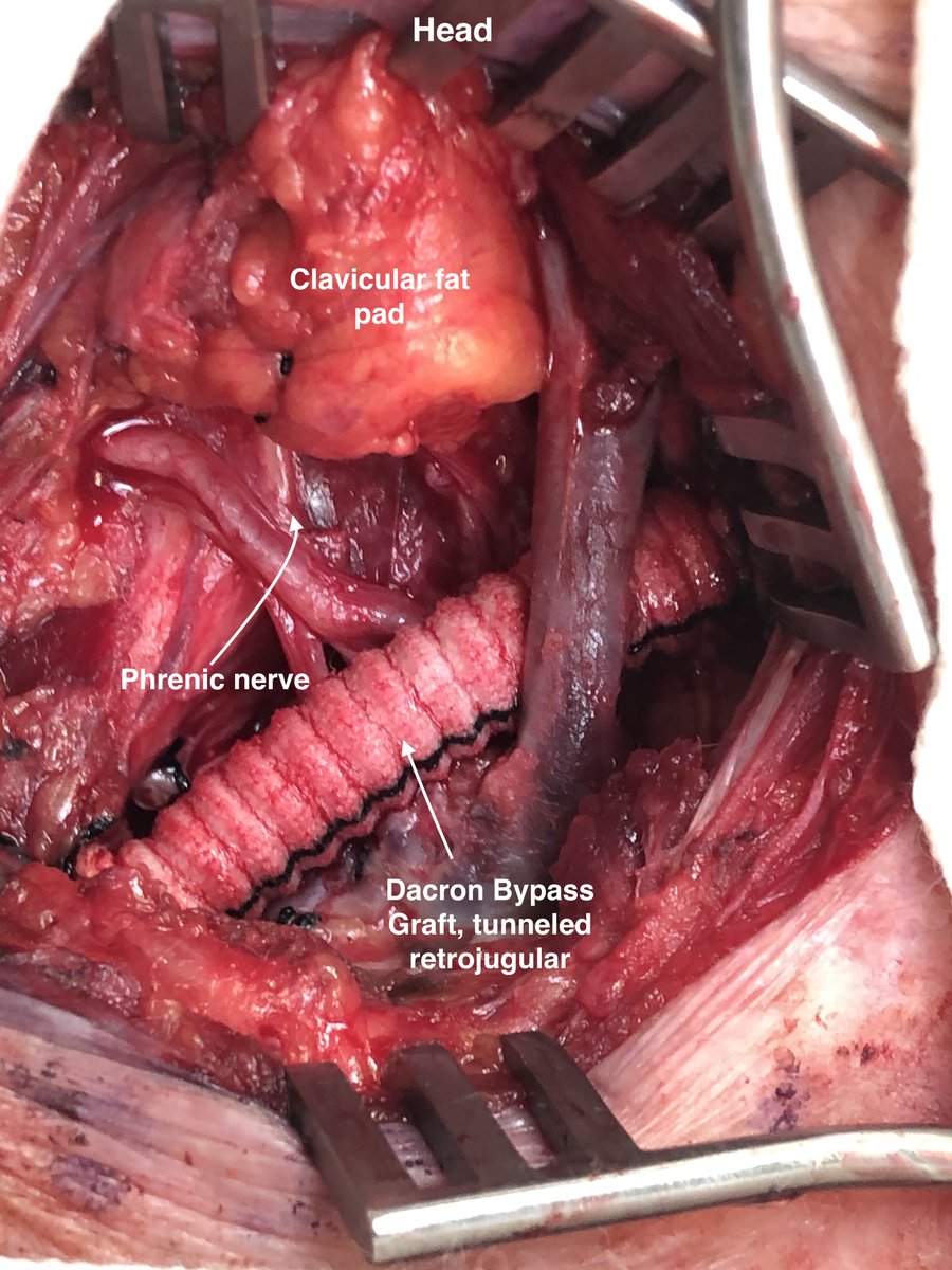 This patient presented with progressive dry necrosis to the fingertips. Angiogram showed severe proximal stenosis. Given the proximity to the vertebral artery, a stent was not placed. This patient was treated with carotid-subclavian bypass with ligation of SCA. #vascularsurgery