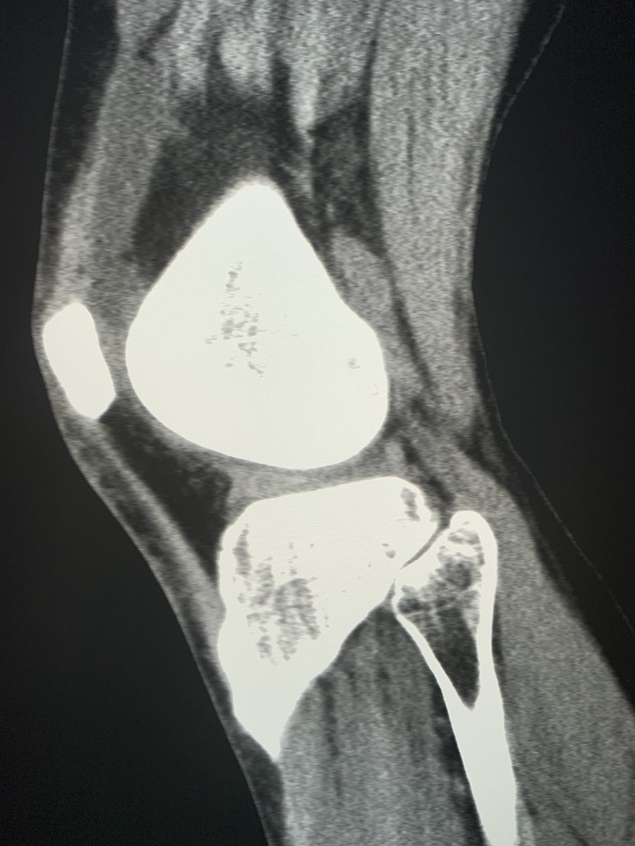DanielWessellMD's tweet photo. Great call by our @MayoFL_MSK fellow @TylerBurgner on this #RuleOutFx CT #MSKRad #radres #DoubleDelta #WhenUKnowTheFellowIsReadyToGraduate https://t.co/XRn31d0ys6