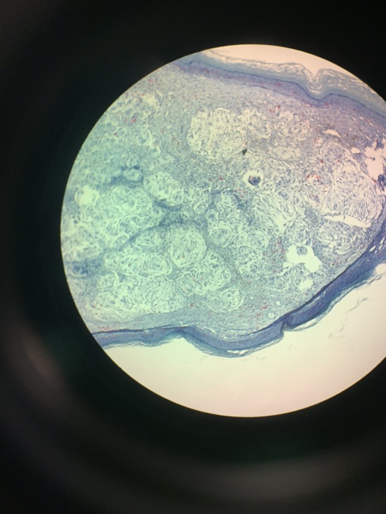 Stains for s100, sox10, cd31 and pan-keratin were negative. Cd68 highlighted something scattered histiocytes. BMI-c3 was positive