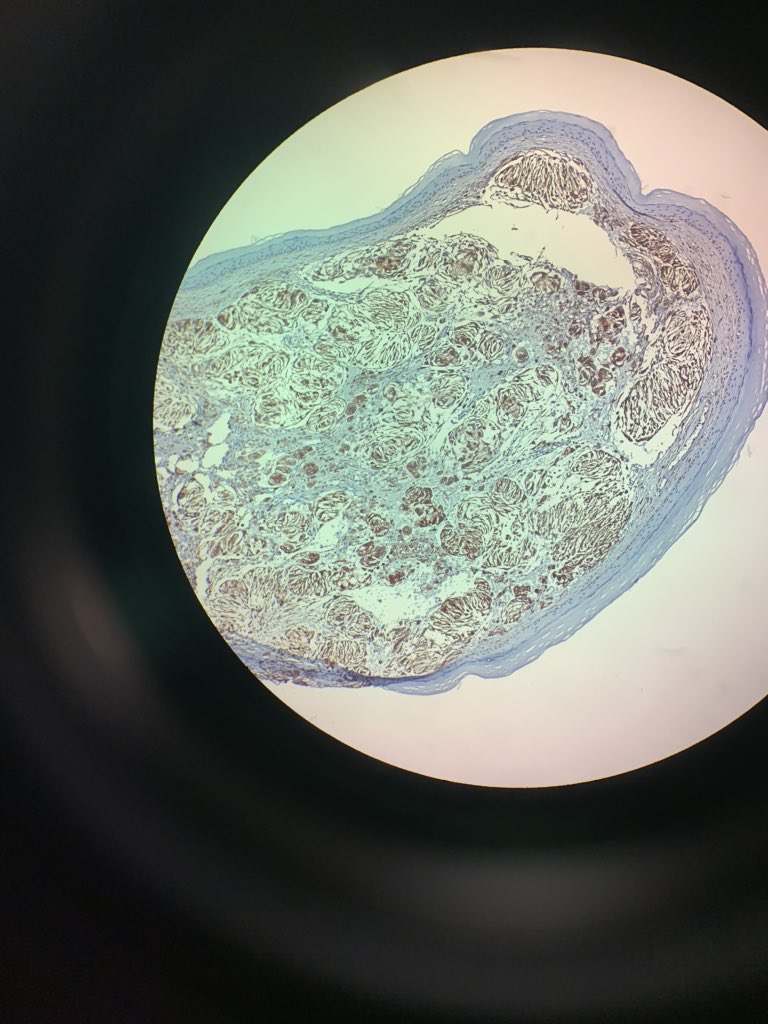 Stains for s100, sox10, cd31 and pan-keratin were negative. Cd68 highlighted something scattered histiocytes. BMI-c3 was positive