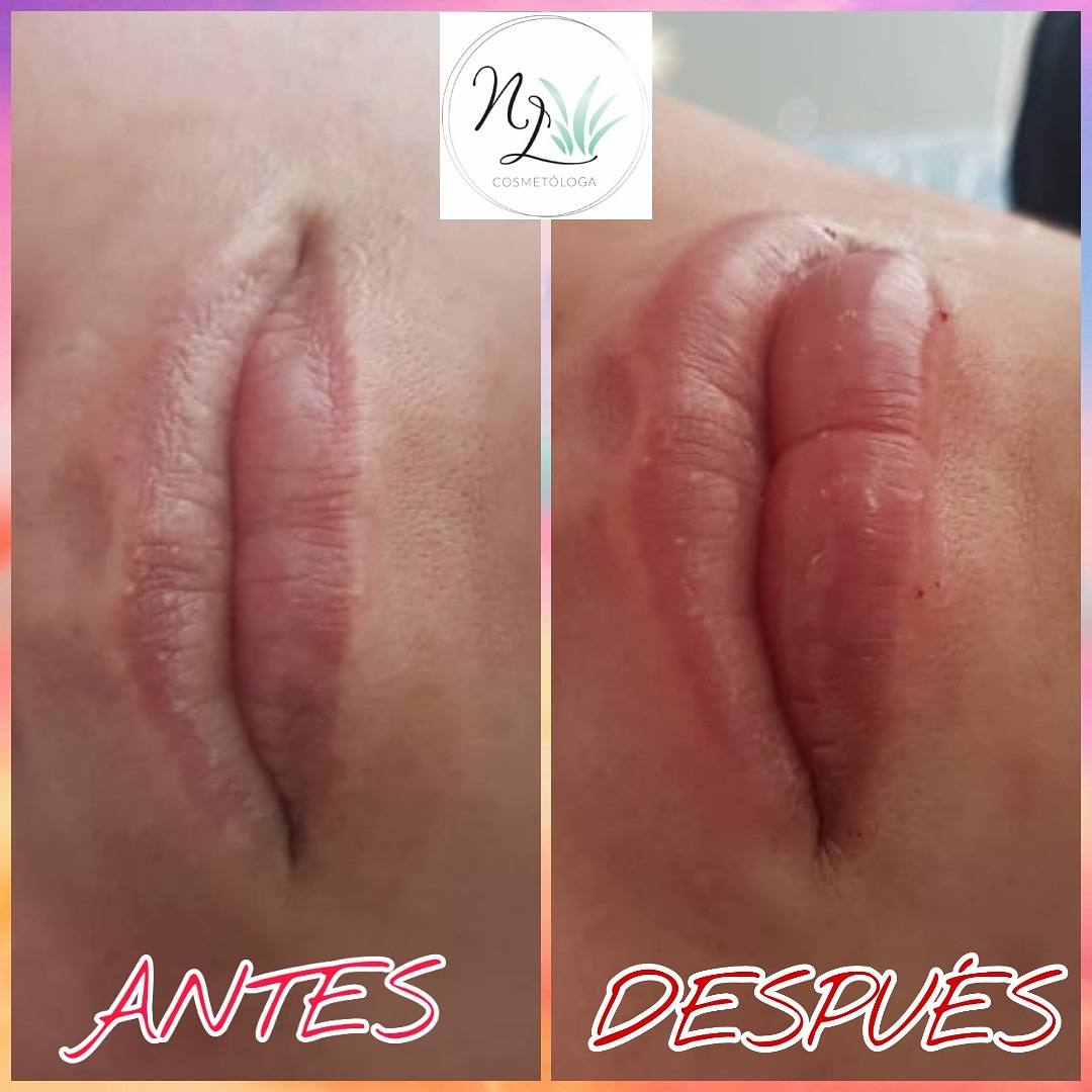 andresrivera23's tweet photo. Perfilamiento y relleno de labios con ácido hialurónico...sigue a @natycosmetologa en instagram para conocer este y más tratamientos. https://t.co/fShrvA8ERu