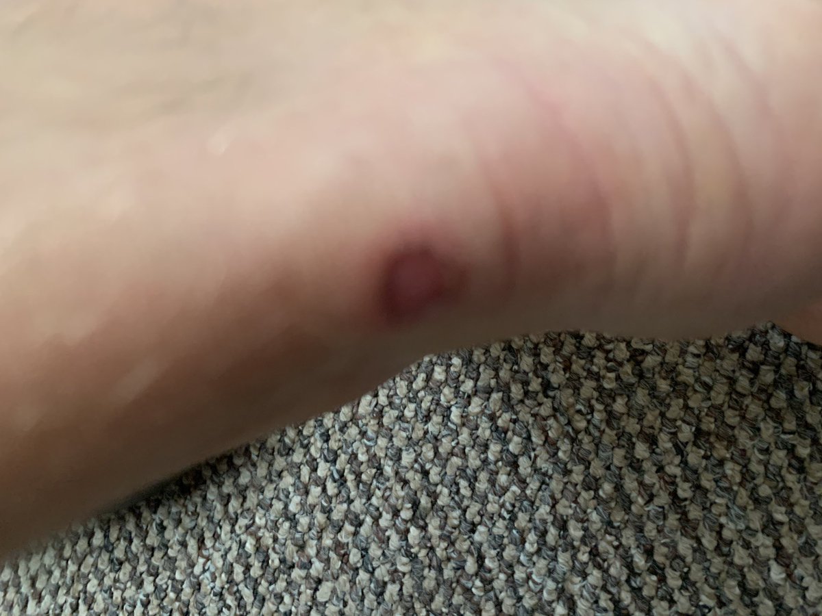 jtech4learning's tweet photo. @ASOS_HeretoHelp bought some trainers. Wore them once (for 10 minutes) outside of the house and they gave me very painful blisters on both ankles. Can I return for a full refund? https://t.co/lvXQNwNycL