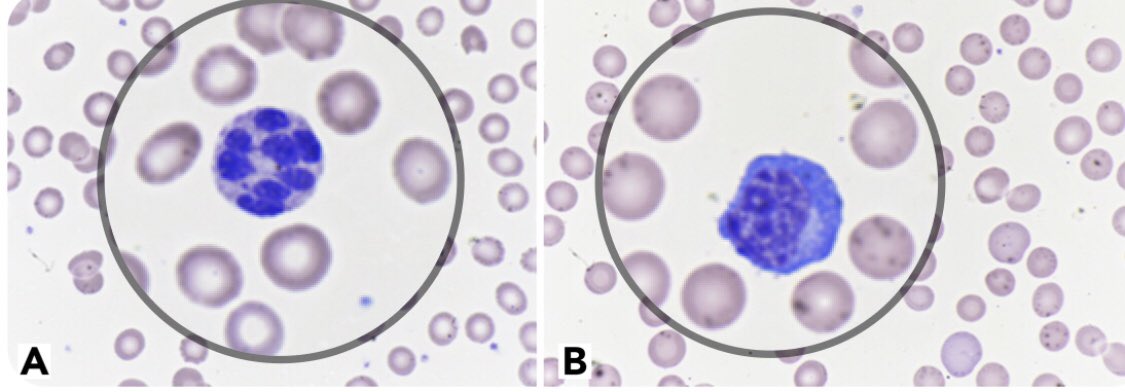 feldstej's tweet photo. #congrats #drsalib #covid-19 #hypersegmented #neutrophils #plasmacytoid #lymphocytes #blood #heme #hemepath https://t.co/k05D2sWSGo https://t.co/eh81d6geHE