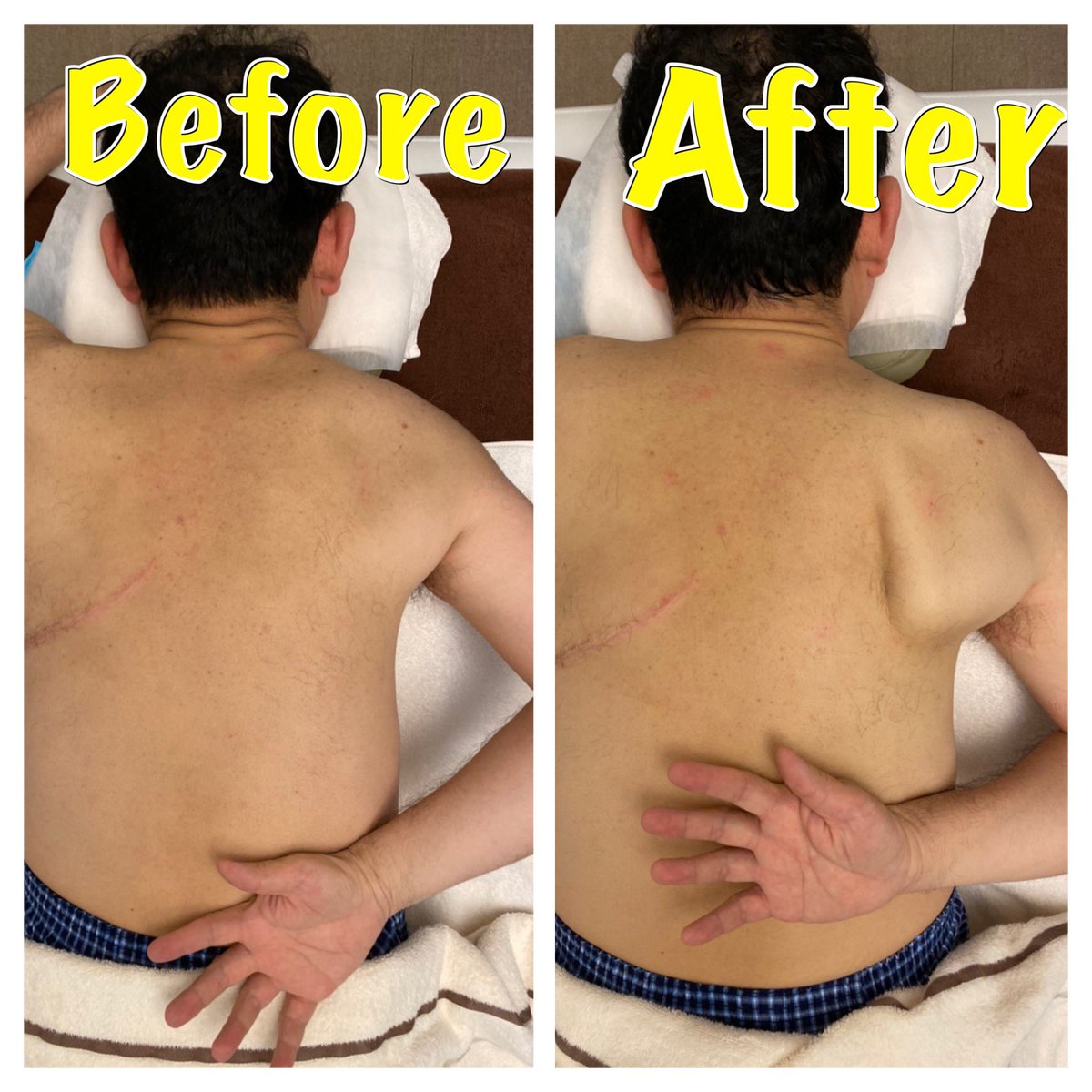 竹内電力整体 押上大黒湯 流筋で肩甲骨剥がし 肩凝り 40肩の原因は肩甲骨の硬さ 腕を背中に回し肩甲骨が浮き出ない人は硬いので要注意ですよー ゆる湯る本日も23時まで営業しておりますので 施術希望の方はlineにて宜しくお願い致します T