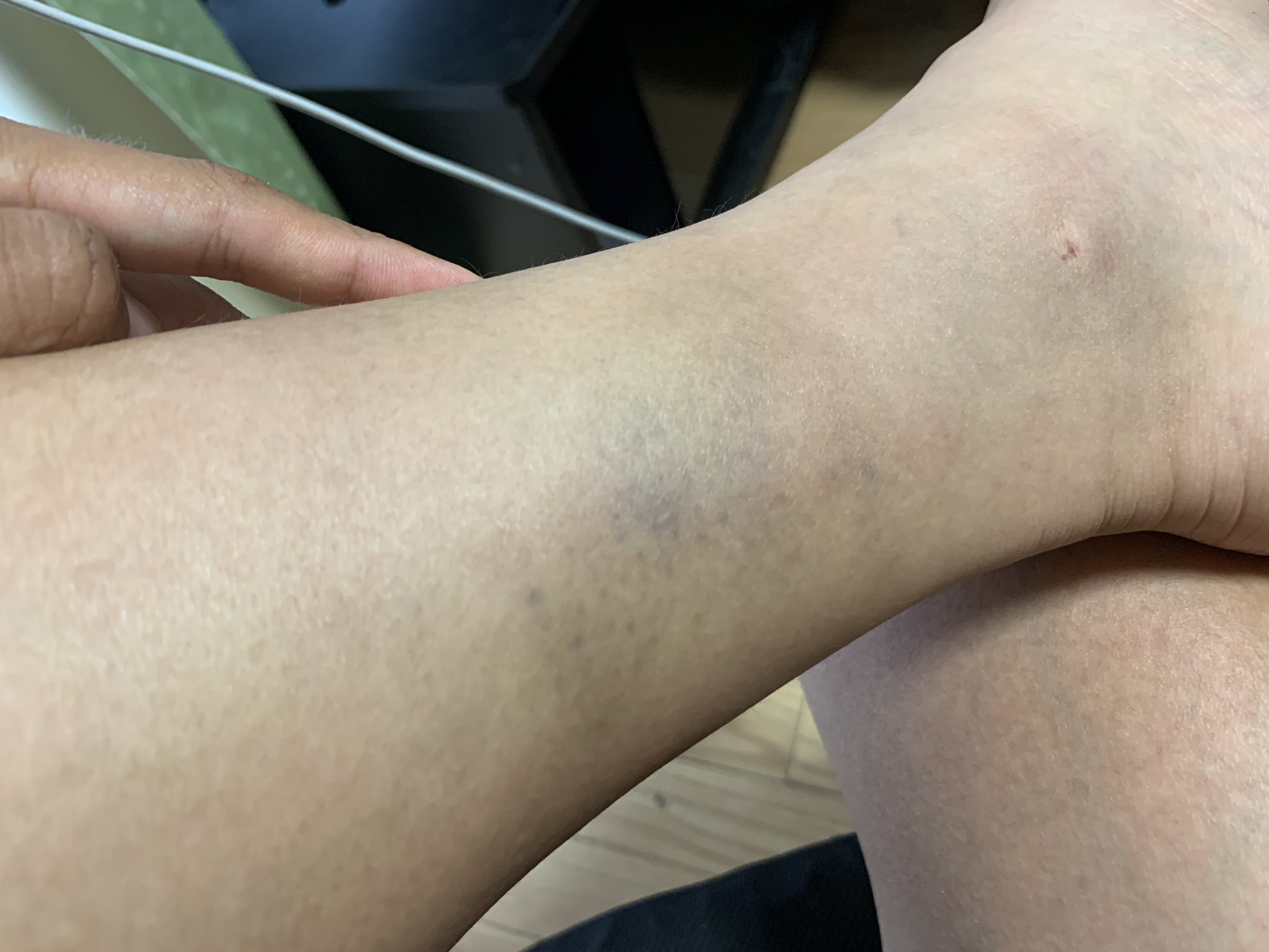 تويتر 篠 على تويتر 2日前にクリート折れた時の くるぶし ちょっと抉られたのと 左の足具よりちょい上の打撲 もう青アザに変わったけど治るまでかかりそう 右より2cm太いぐらい腫れてる T Co Obwjecbumt