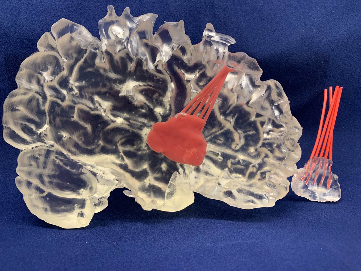 Finished two educational models for the neurosurgical department. The level of accuracy needed to perform this type of surgery is amazing. Printed in a Form3B using Clear resin that has been polished. Red colored resin was then poured inside the model and cured.