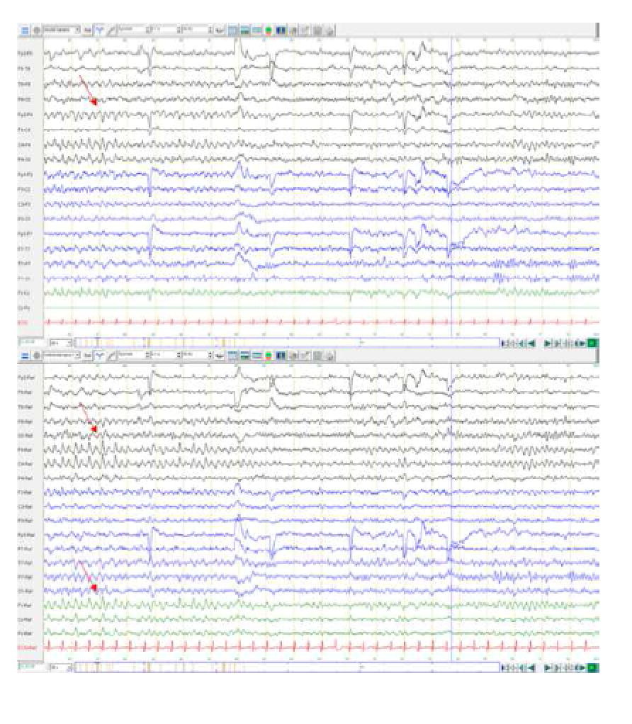 ClinicalNeuroph's tweet photo. [COVID19 and cerebral microbleeds] De Stefano et al.: “To our best knowledge, this is the first reported case of Critical Illness-Associated Cerebral Microbleeds related to SARS-CoV-2 infection.” [in press]

https://t.co/ONuMiueEdO
#ClinicalNeuroph #COVID19 #Microbleed https://t.co/bj8wM0Q5tm