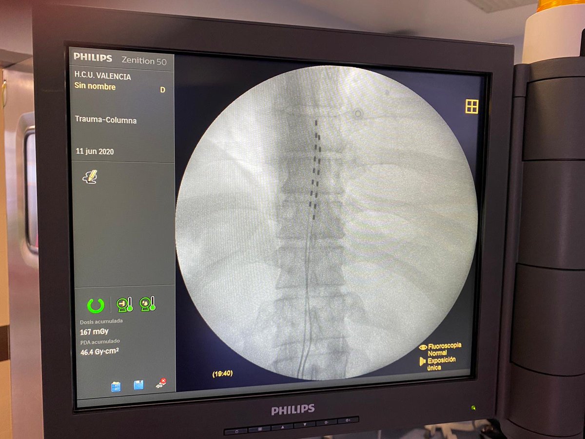 jcarlostornero's tweet photo. Ayer, Jueves 11 de Junio 2020 en el Hospital Clínico Universitario de Valencia implantamos el primer SCS DTM Medtronic de Europa.
Nuevas terapias de estimulación medular que mejoran la calidad de vida de los pacientes con Dolor!!! #DTMSCS @GVAclinic @GVAsanitat https://t.co/f3AnzfqdS0