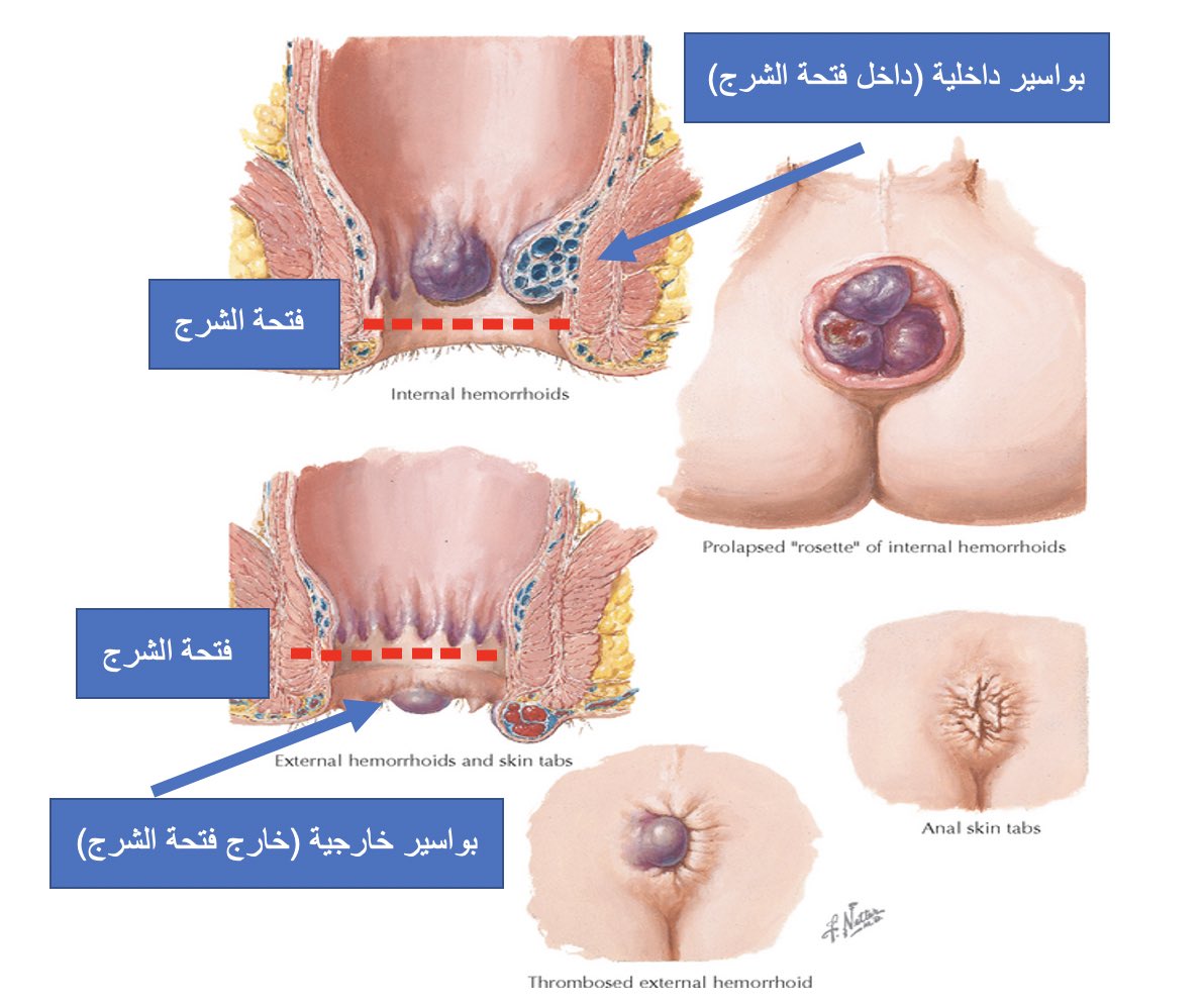 في الاخراج حبه فتحة 4 خطوات