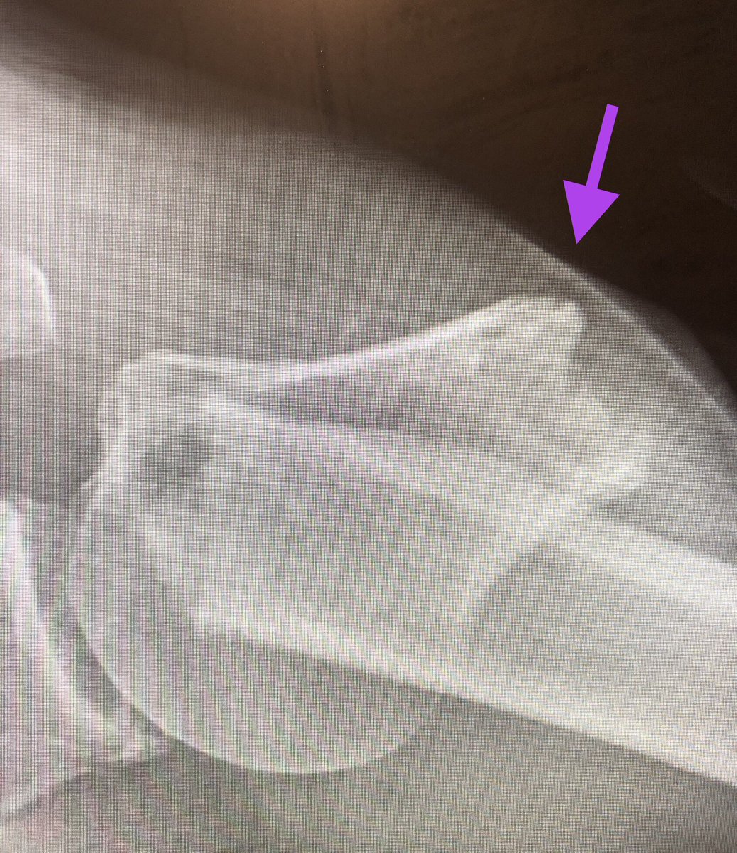 [1/4] Impressively displaced proximal humerus with 90 degrees of varus. This person was elderly but I couldn’t in good conscience treat this nonoperatively, that’s basically a guaranteed nonunion. It almost made it out of the skin (arrow) - watch for open wounds if you see this.