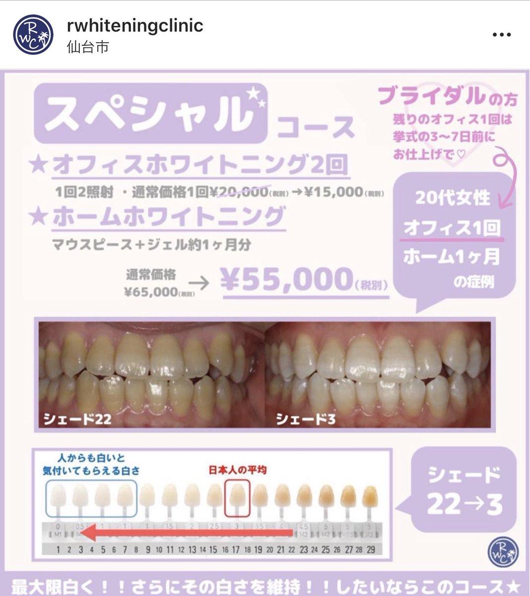ブライダルホワイトニング