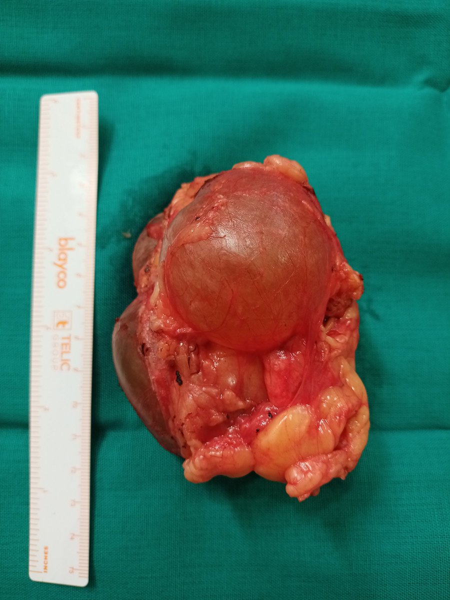 JLBlasLaina's tweet photo. Curioso caso de tumoración quística polilobulada adrenal izquierda. Exéresis laparosópica. Pendiente de anatoía patológica.
@jftrebolle #cirugiahrv https://t.co/TYTuvOIruN
