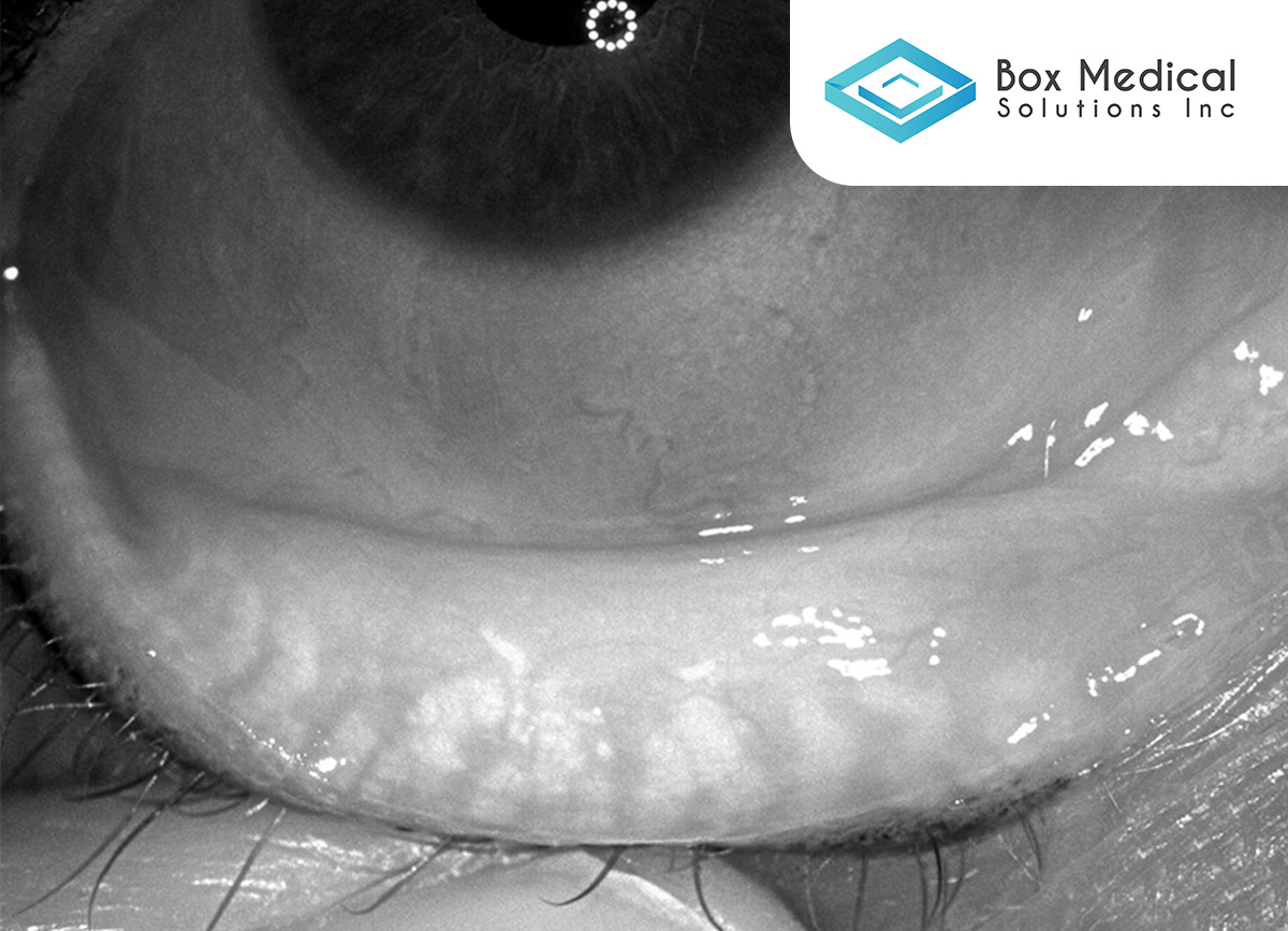 ScienceBasedHth's tweet photo. Drs. Hauswirth &amp; Bloomenstein discuss #meibography, the role it plays in a practice, and the many layers of treating #dryeye in patients. Listen here: https://t.co/dYEnyDwKAL @DryEyeCoach @drwhauser https://t.co/Jw8RNoBAgp