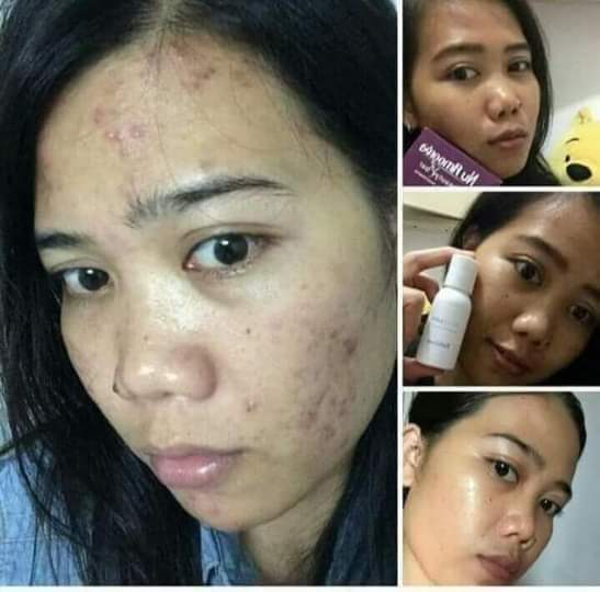 Muwiyahgmailco1's tweet photo. Dari yang jerawat paraaah
Sampe bopeng2
Dan akhir nya sehat lagi
😍😍😍😍😍😍 
Alhamdulillah makin cinta sama nuamorea😘😍😍😎😎

Wa 087853095127 https://t.co/ppqnuyfeZE