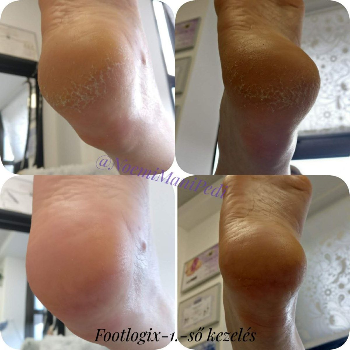 NoemiManiPedi's tweet photo. Footlogix - Szike mentes Pedikűr 😍Előtte - utána👣 Csodákat művel 💪👣

#footlogix #sarokrepedés #pedikur #pedikurarak #pedicure #gyogypedi #készülj #nyar #labak #lábápolás #tyukszem #benottkorom #szemolcs #borkemenyedes #simalakk #japanmanipedi #géllakk #xxiker #csepel #gellakk https://t.co/EDCbhXdWRE