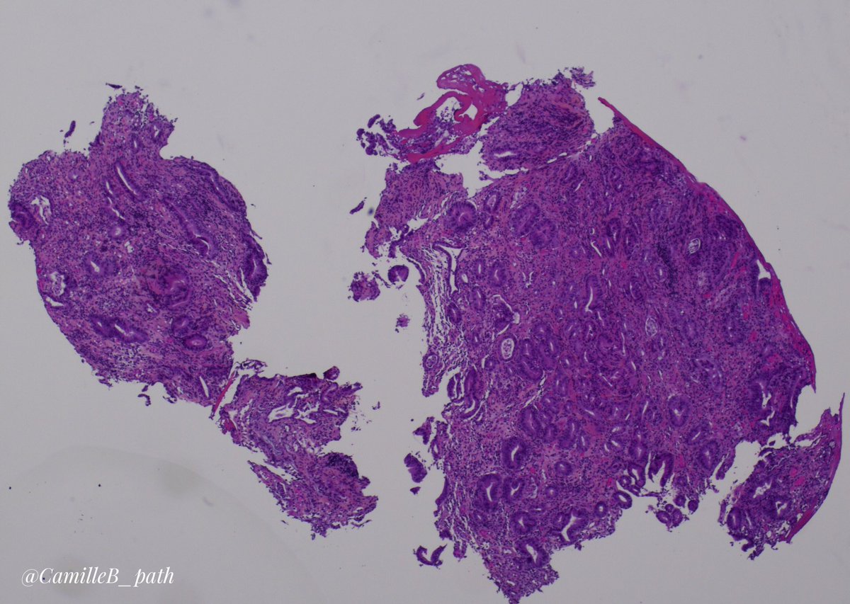 CamilleB_path's tweet photo. Gastric Antrum biopsies in an old women 
Past of melanoma

Hint: no Helicobacter 

#GIpath #pathology https://t.co/qYGunuDEjw