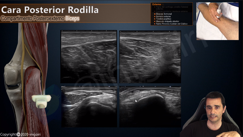 inigoiri's tweet photo. Terminando un nuevo vídeo para mi canal de YouTube:
Ecografía de Rodilla parte 3: Cara posterior
Si quieres estar informado sobre este y próximos vídeos suscríbete a mi canal de Anatomía y Ecografía Musculoesquelética:
https://t.co/lju8qJbGf2 https://t.co/8hDthofkXd