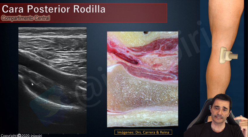 Terminando un nuevo vídeo para mi canal de YouTube:
Ecografía de Rodilla parte 3: Cara posterior
Si quieres estar informado sobre este y próximos vídeos suscríbete a mi canal de Anatomía y Ecografía Musculoesquelética:
youtube.com/c/inigoiri?sub…