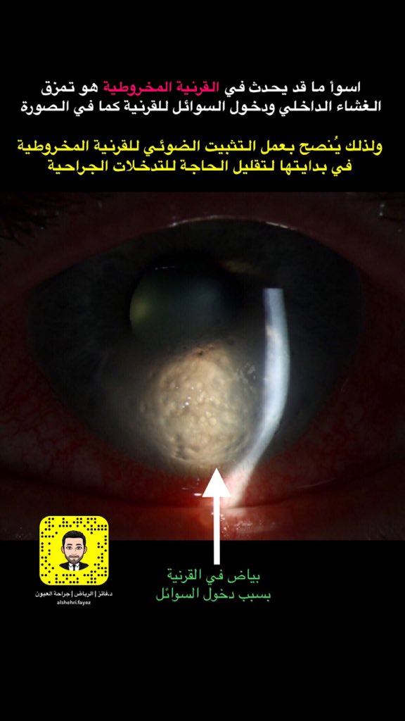 أحد مضاعفات القرنية المخروطية هو تمزّق الغشاء الداخلي للقرنية ودخول السوائل داخل أنسجة القرنية.
ولذلك يُنصح بعمل التثبيت الضوئي للقرنية المخروطية في بدايتها لتقليل الحاجة للتدخلات الجراحية بإذن الله.