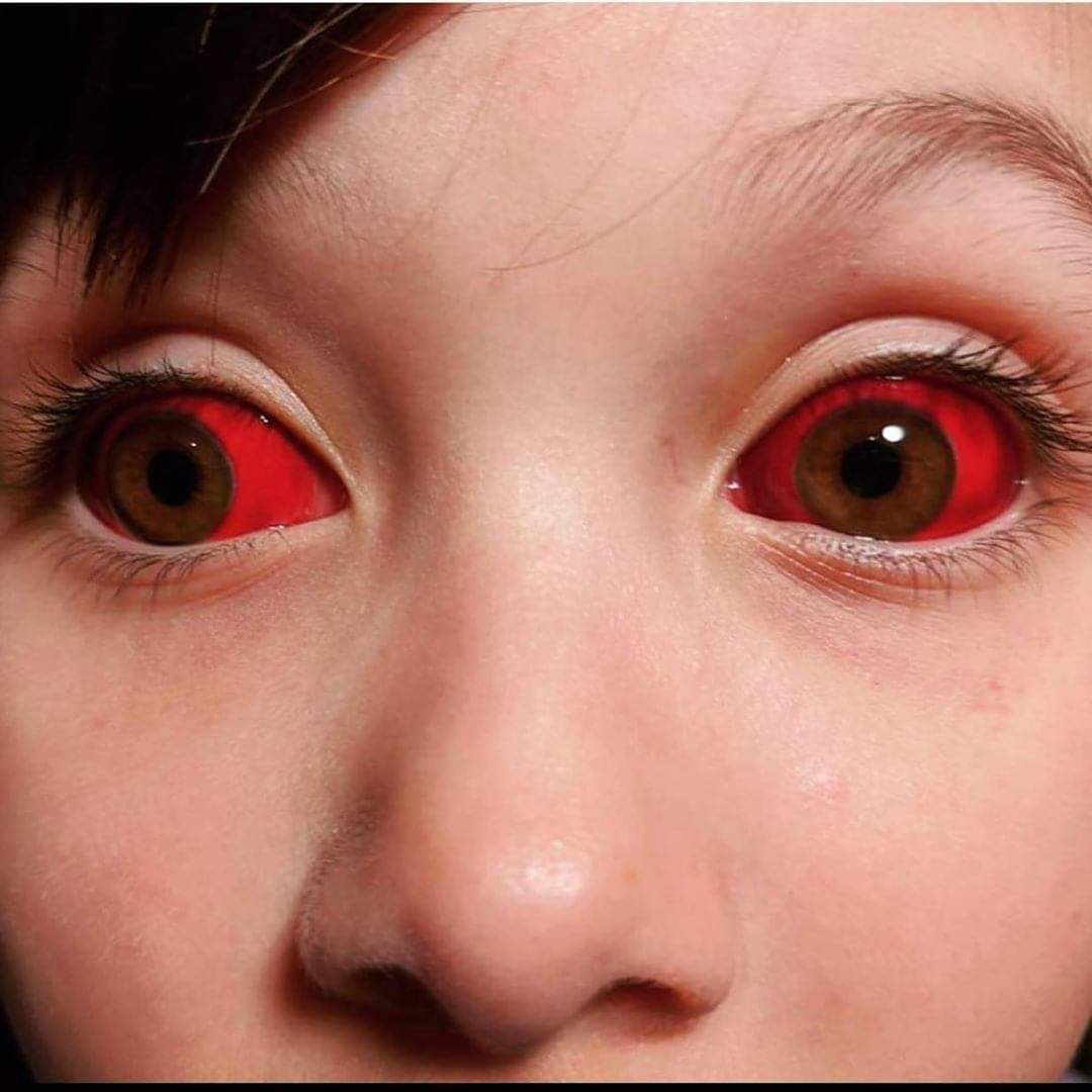 medicolearning's tweet photo. Have you ever seen something like that!

Patient with a spontaneous subconjunctival hemorrhage conjunctiva is the clear tissue that covers the white of the eye (the sclera) and lines the inside of both eyelids.  A subconjunctival hemorrhage is blood from a tiny broken https://t.co/pPnYPfXeUS