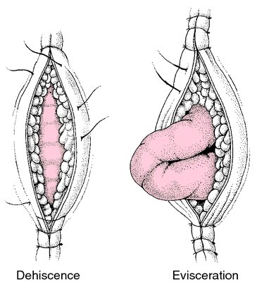 CiruAndes2's tweet photo. Dehiscence and evisceration: a big graphical difference! #SoMe4Surgery #SoMe4ColSurg @MISIRG1 @pferrada1 @SWexner @juliomayol @sminaev2015 @NeilFlochMD @almagoch @FitSurgeon @TecSurgeon https://t.co/gTK68UxV7J