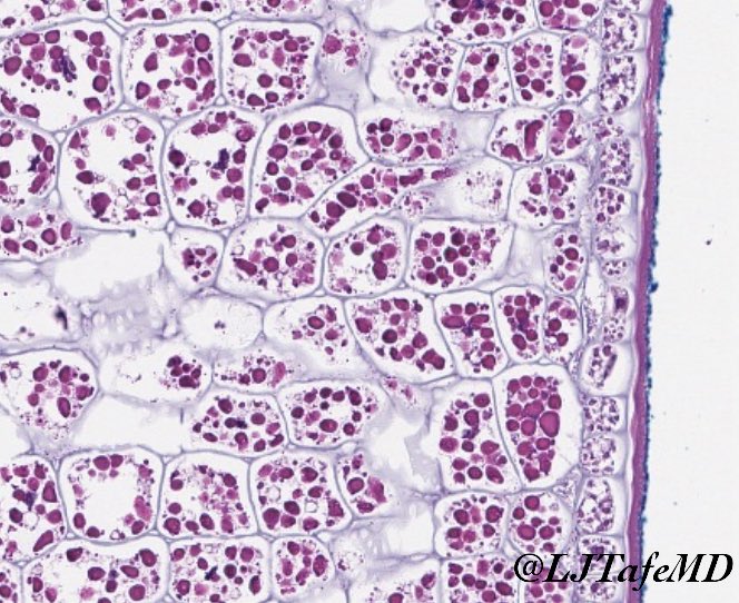LJTafeMD's tweet photo. 60s yo man with large hypopharyngeal tumor.  This biopsy submitted as “necrotic cartilage”.  What do you think? #ENTpath #HNPath #SurgPath https://t.co/r3saW98C0X