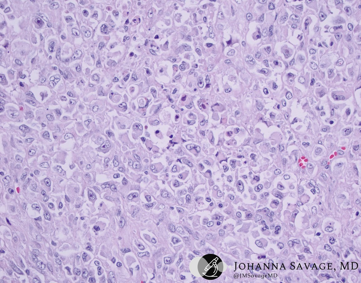 #gynpath #ovary #OSUWexMed 

A late Friday treat: Ovarian mass

What would you want to know about this patient?
What would be your work-up and diagnosis?

Follow-up to come on Monday...