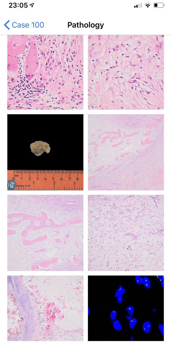 BoSTT_app's tweet photo. Case No 100! Tks everyone. Tks @RNOHnhs. What a milestone. One hundred cases #BSTpath #MSKrad tumours, learning points, >1000 annotated images, >10000 users. #pathology #radiology #sarcoma #FOAMed #FOAMrad https://t.co/6oI5d4qgQY