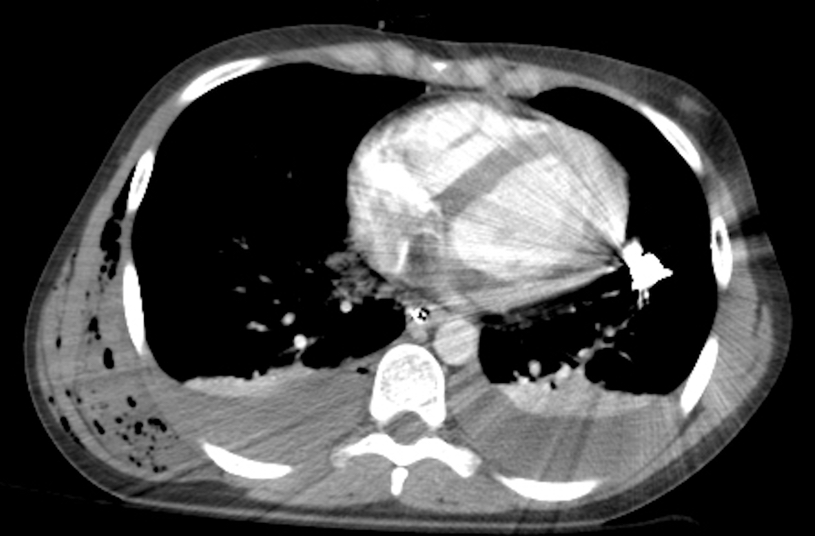 Do not minimize the significance of a small pericardial effusion in these trauma patients with concern for penetrating cardiac injury. Of note, the bilateral hemothoraces were detected on eFAST exam. This patient never hypotensive-taken to CT enroute to OR. Good outcome.